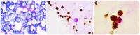 Diagnostic pitfall: primary effusion lymphoma with rare cytokeratin immunoreactivity