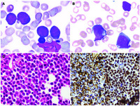 Gray-zone lymphoma: a complex reality