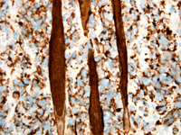 Alveolar rhabdomyosarcoma desmin immunostain