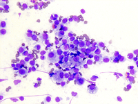 Langerhans cell histiocytosis Diff-Quik-stained touch imprint