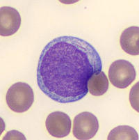 Myeloblast with Auer rod