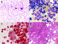MDS/MPN with ring sideroblasts and thrombocytosis masquerading as prefibrotic/early primary myelofibrosis