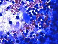 aCML marrow