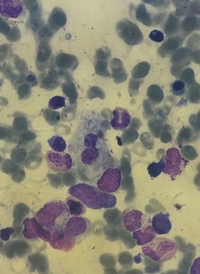 Gaucher disease 1