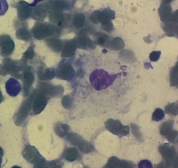 Gaucher disease 2
