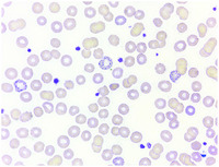 Coarse basophilic stippling in lead poisoning