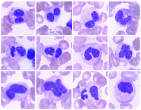 Dysplastic neutrophils in the bone marrow of a Shwachman-Diamond syndrome patient