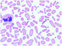 Sickle cell trait with β-thalassemia, elliptocytosis, and thrombocytosis