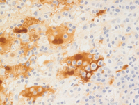 Emperipolesis in Rosai-Dorfman disease