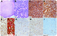 Cyclin D1–negative mantle cell lymphoma with aberrant CD3 expression