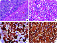Crystal-storing histiocytosis associated with thymic extranodal marginal zone lymphoma