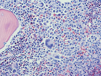 Mast cell Leukemia