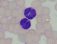 Marrow involvement in cutaneous T-cell lymphoma