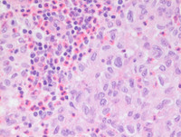 Langerhans Cell Histiocytosis