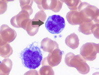 Sezary cell