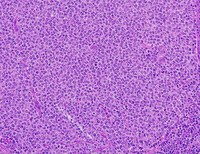 LBCL with IRF4 H&E medium 200x