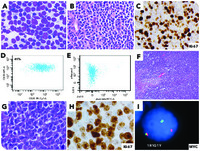 Testicular double-hit lymphoma in a patient with history of follicular lymphoma with high proliferation index