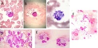 Detection of Disseminated Histoplasmosis on Peripheral Blood Smear in an Immunocompetent Patient from Non Endemic Area.