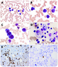 HHV8-associated lymphoproliferative disorder in the peripheral blood