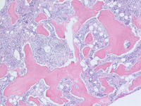 Osteosclerosis