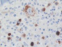 CHL Marrow CD15