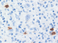CHL Marrow CD20