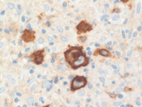 CHL Marrow CD30