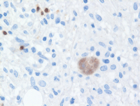 CHL Marrow PAX5