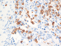 JMML-Myeloperoxidase