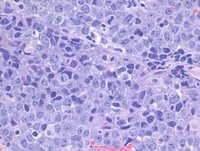 EBV+Plasmablastic lymphoma-HE