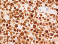 EBV+Plasmablastic lymphoma-MUM1