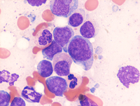 AML-CEBPA-Aspirate