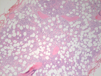 AML-CEBPA