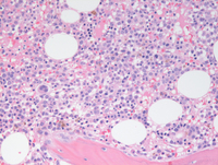 AML-CEBPA-HE