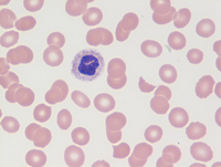 AML-CEBPA-Blood