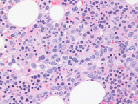 Intravascular DLBCL-Biopsy HE