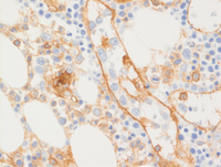 Intravascular DLBCL-CD31