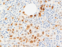 Intravascular DLBCL-MUM1