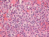 APL-Biopsy
