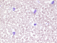 MPN-Polycythemia Vera