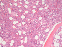MPN-Polycythemia Vera