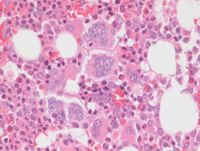 MPN-Polycythemia Vera
