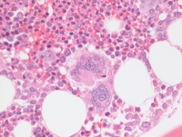 MPN-Polycythemia Vera