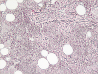 MPN-Polycythemia Vera