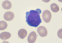 Blebs in T-PLL cells
