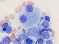 BPDCN-Aspirate