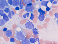 BPDCN-Aspirate