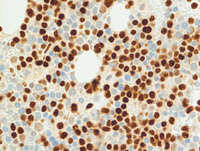 BPDCN-TCF4