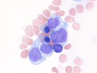 BPDCN-Aspirate