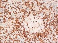Lymphomatoid granulomatosis-CD3